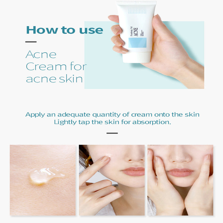 Acne Cream  1.7 Fl. Oz,50ml